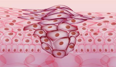 An artist's rendering of cancer cells clustering among healthy cells. Credit: iStock via rights purchase / not a press handout / not for redistribution outside Georgia Tech
Generic cancer cell illustrations available at iStock/Getty Images.