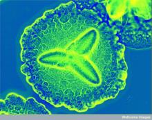 Bacteria behind acute periodontitis. Aggregatibacter actinomycetemcomitans most often lives peacefully in the mouth until circumstances lead it to become infectious. It forms flower-like colonies, here under a microscope sporting a colorful stain added by a researcher. Aa is gram-negative. Credit: Derren Ready (2012) CIL:38942, CIL. Dataset. https://doi.org/doi:10.7295/W9CIL38942 Creative Commons license