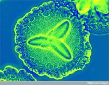 Bacteria behind acute periodontitis. Aggregatibacter actinomycetemcomitans most often lives peacefully in the mouth until circumstances lead it to become infectious. It forms flower-like colonies, here under a microscope sporting a colorful stain added by a researcher. Aa is gram-negative. Credit: Derren Ready (2012) CIL:38942, CIL. Dataset. https://doi.org/doi:10.7295/W9CIL38942 Creative Commons license