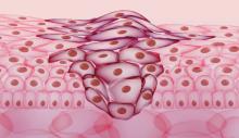 An artist's rendering of cancer cells clustering among healthy cells. Credit: iStock via rights purchase / not a press handout / not for redistribution outside Georgia Tech
Generic cancer cell illustrations available at iStock/Getty Images.